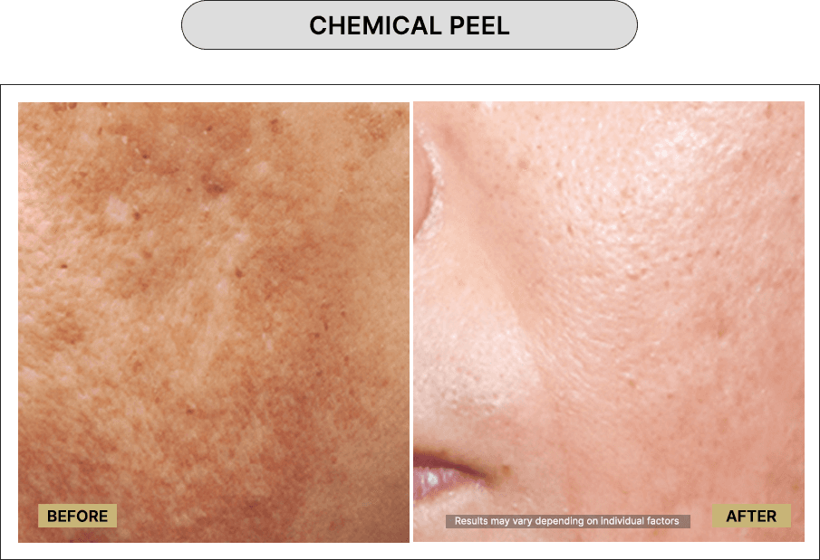 Chemical Peel