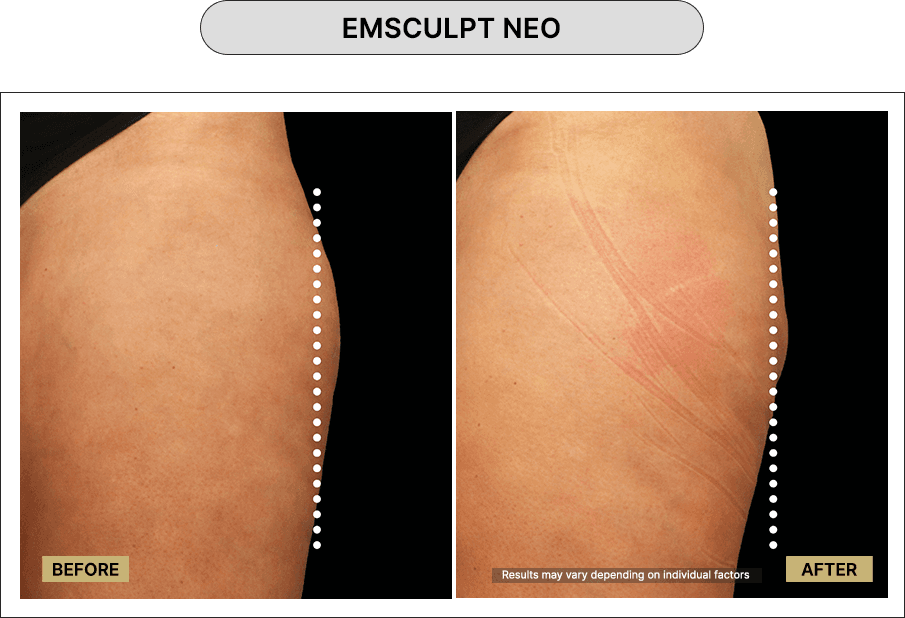Emsculpt NEO