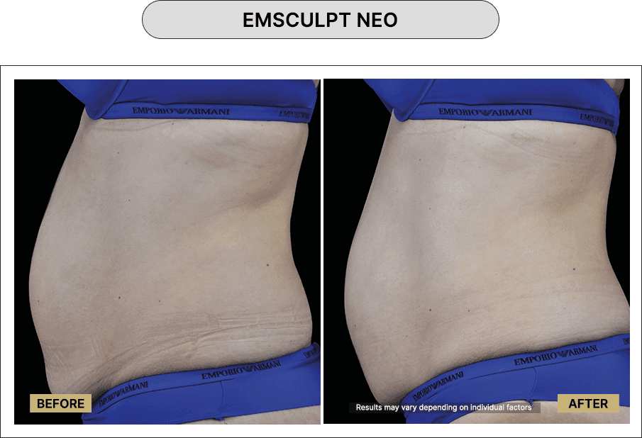 Emsculpt NEO
