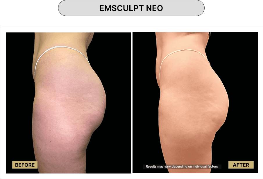 Emsculpt NEO