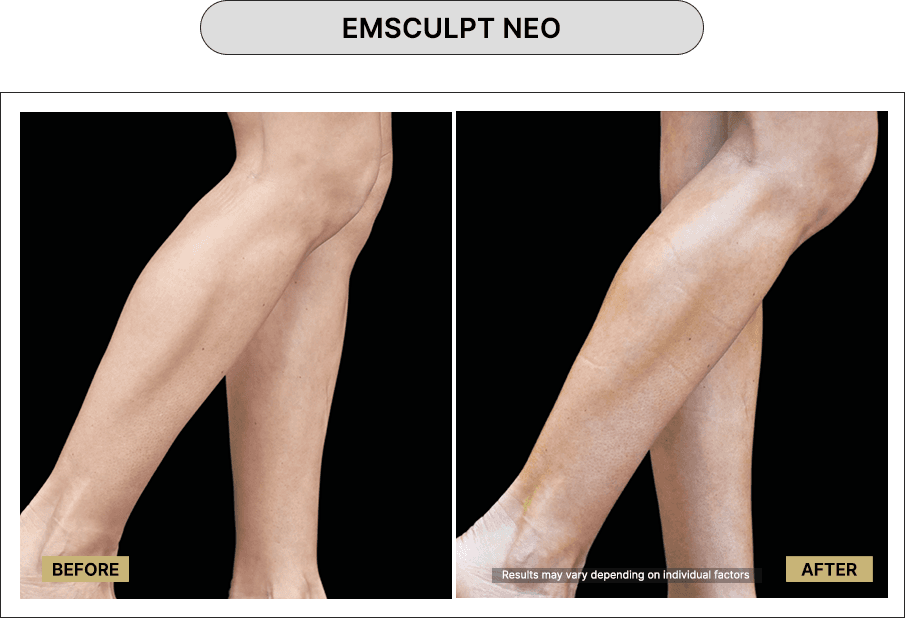 Emsculpt NEO