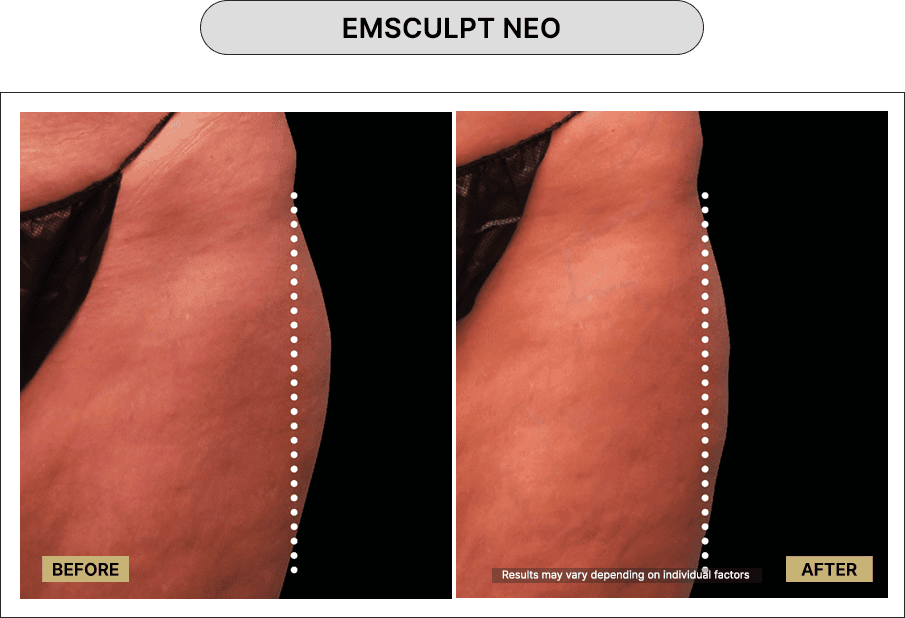 Emsculpt NEO