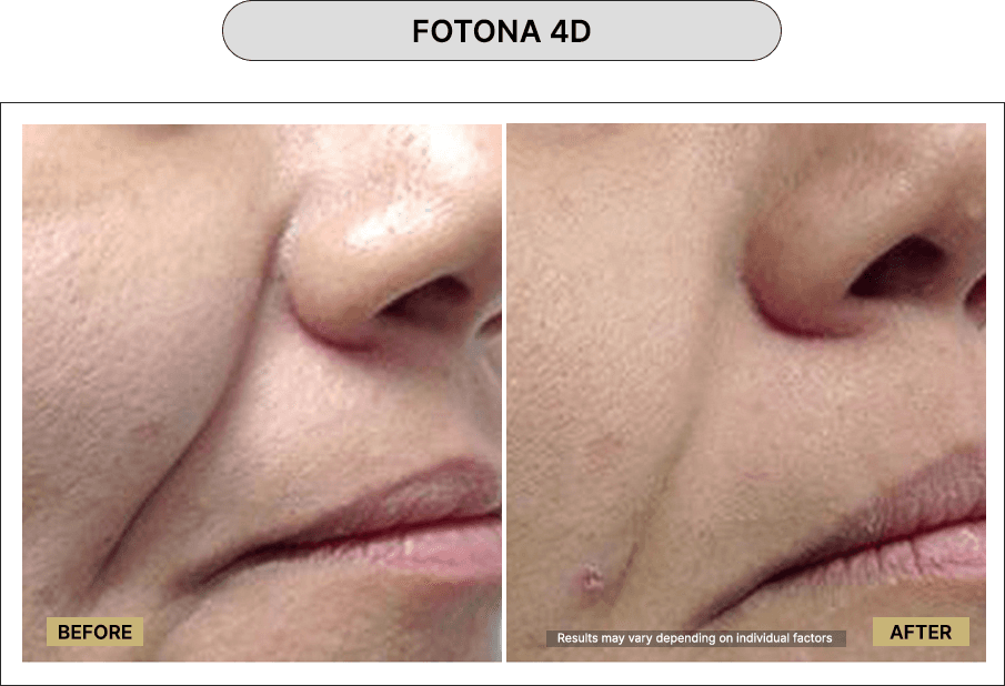 Fotona 4D