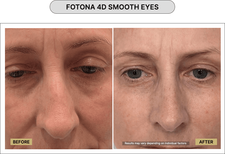 Fotona 4D smooth eyes