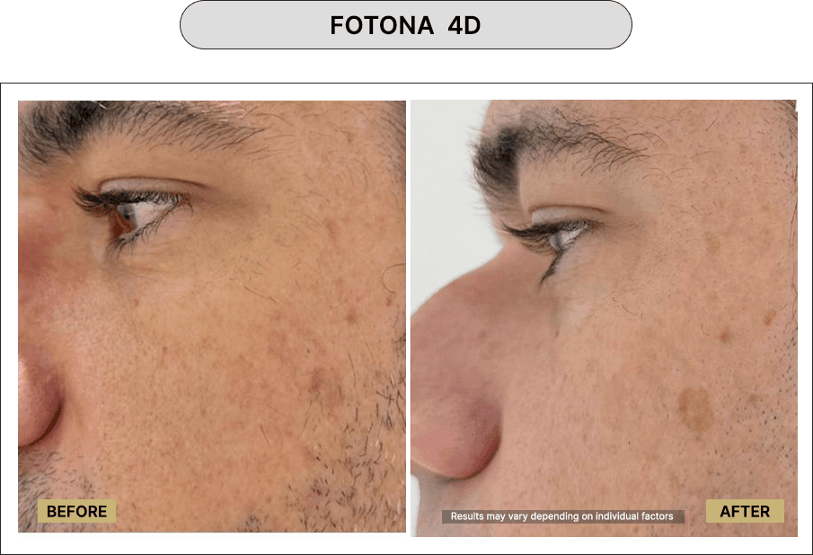 Fotona 4D