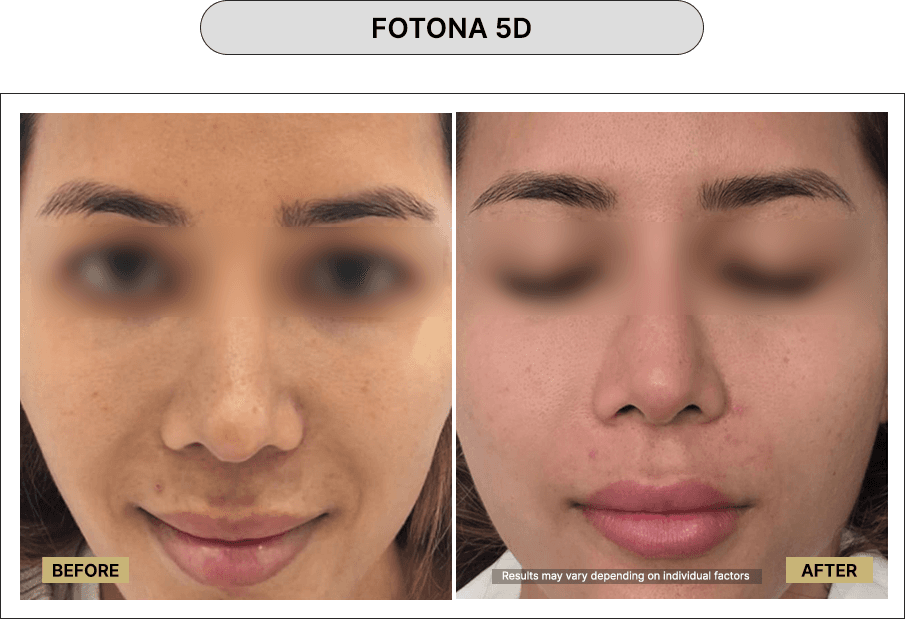 Fotona 5D