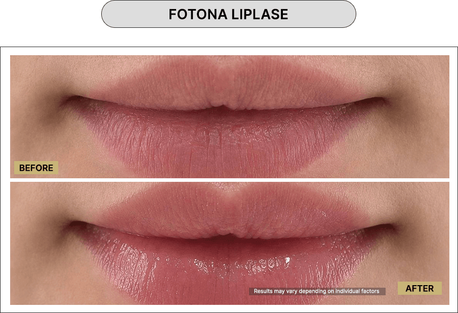 Fotona Liplase