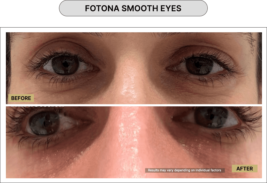 Fotona Smooth Eyes