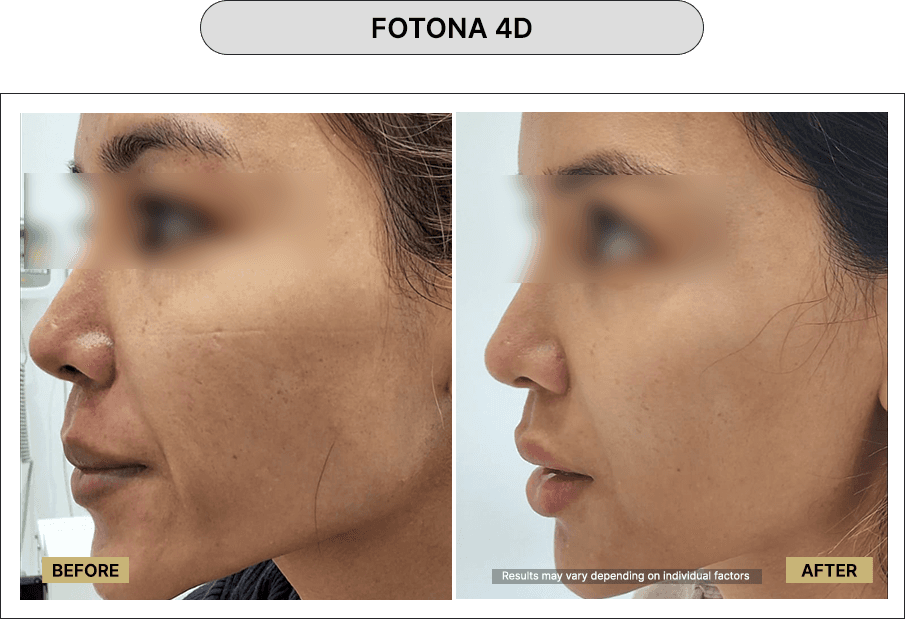 Fotona 4D
