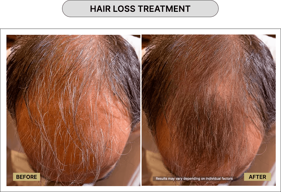 Hair loss treatment