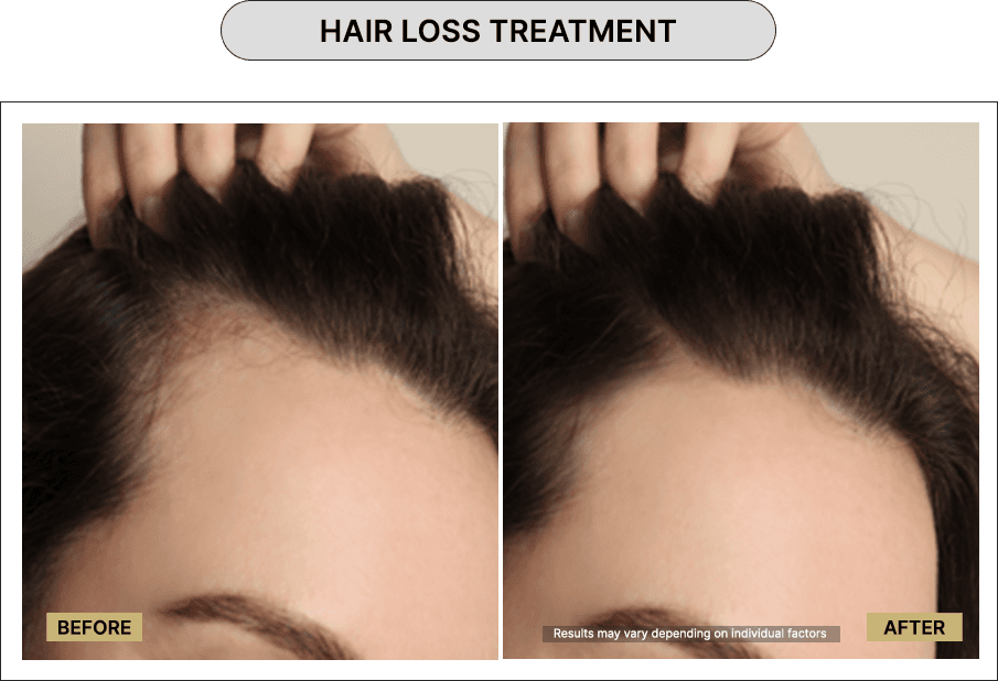 Hair loss treatment