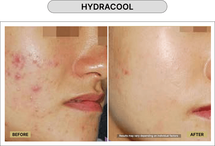 Hydracool