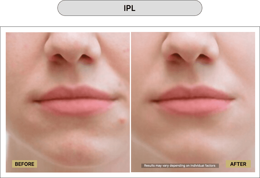 IPL