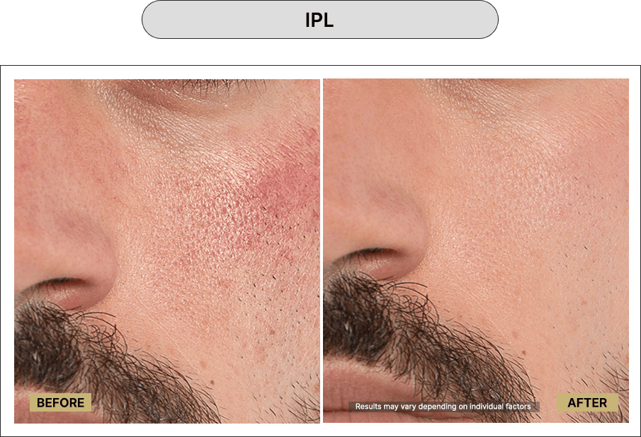 IPL