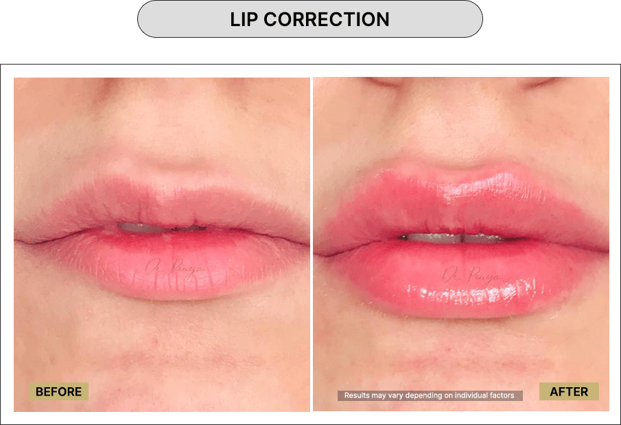 Lip Correction