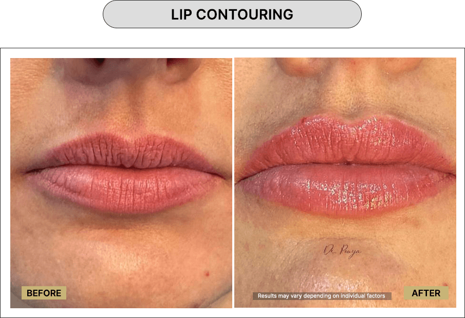 Lip Contouring