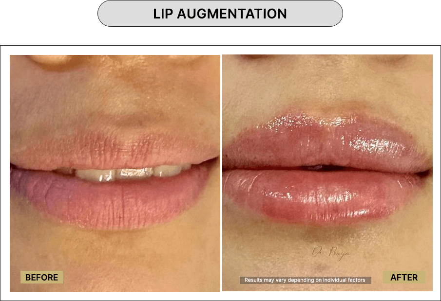 Lip Augmentation