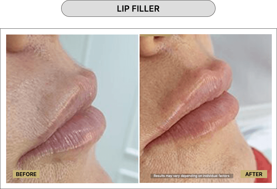 Lip Filler