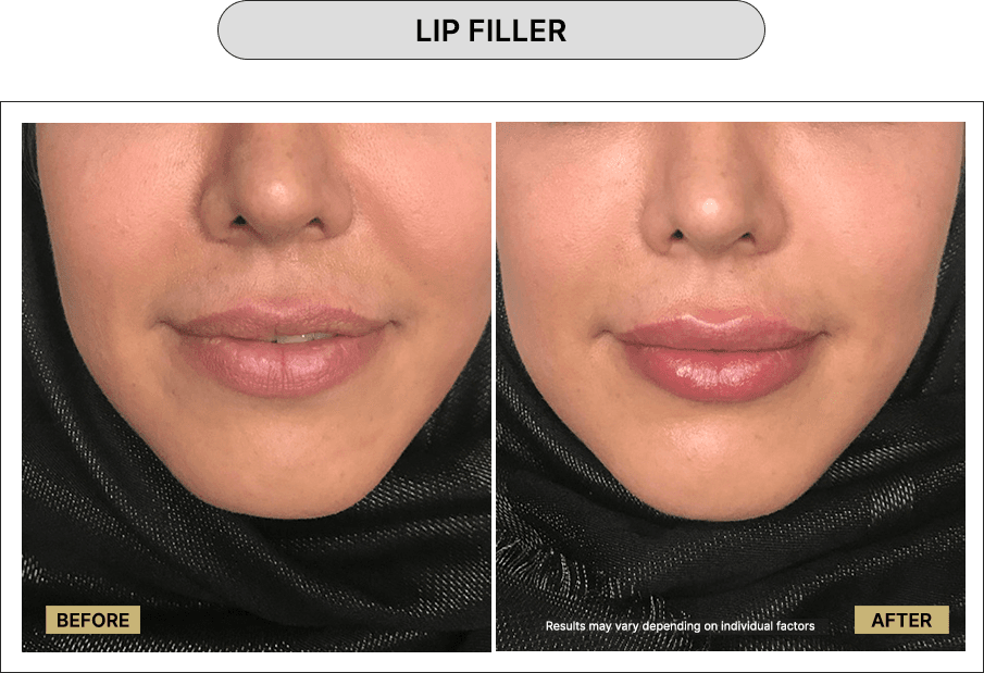 Lip Filler