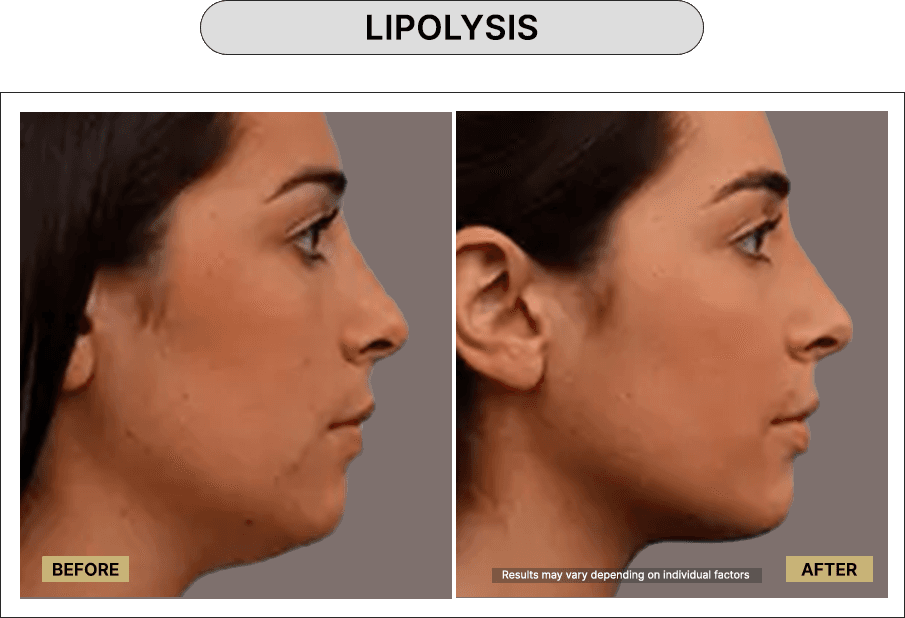 Lipolysis