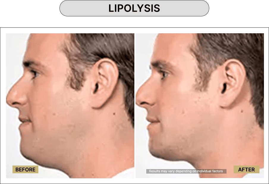 Lipolysis
