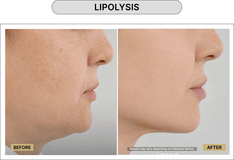 Lipolysis