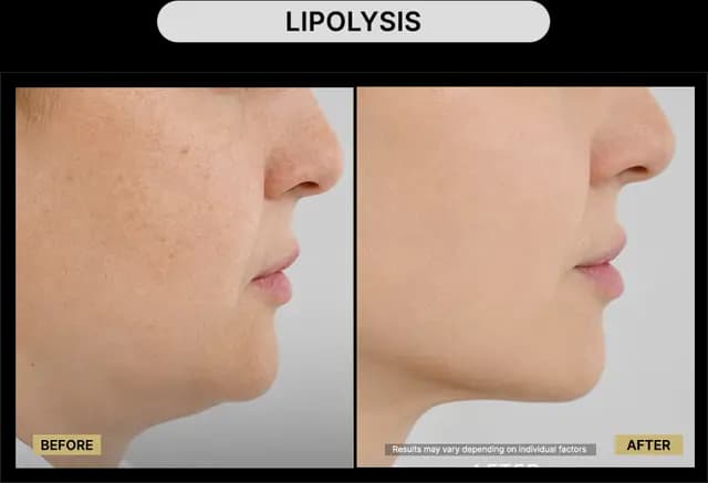 Lipolysis