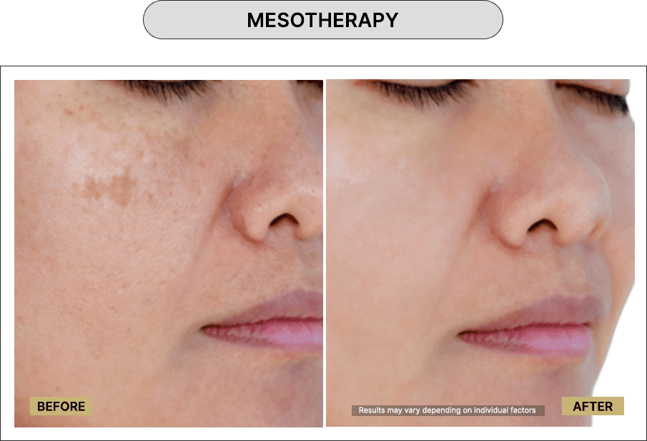 Mesotherapy