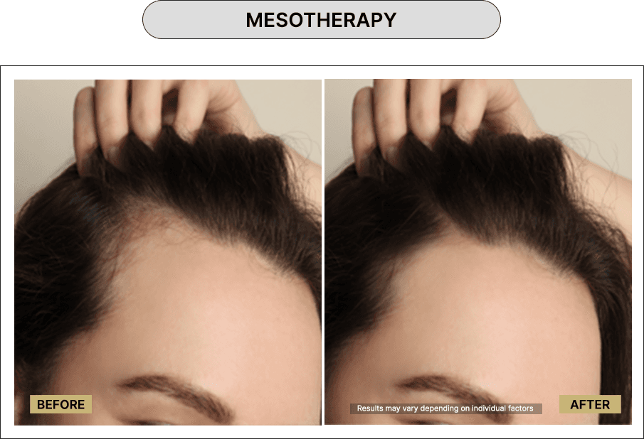 Mesotherapy