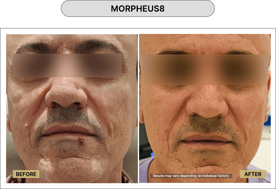 Morpheus