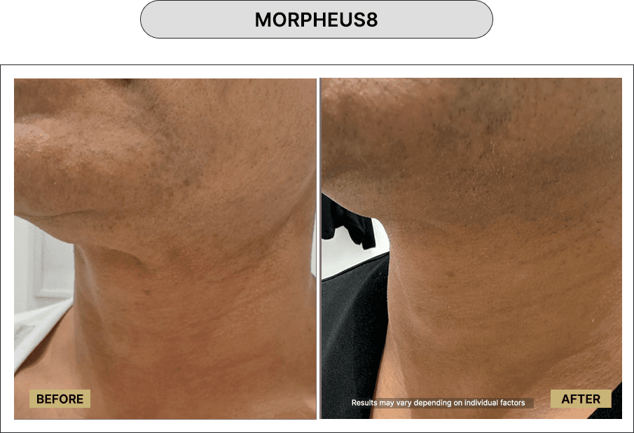 Morpheus