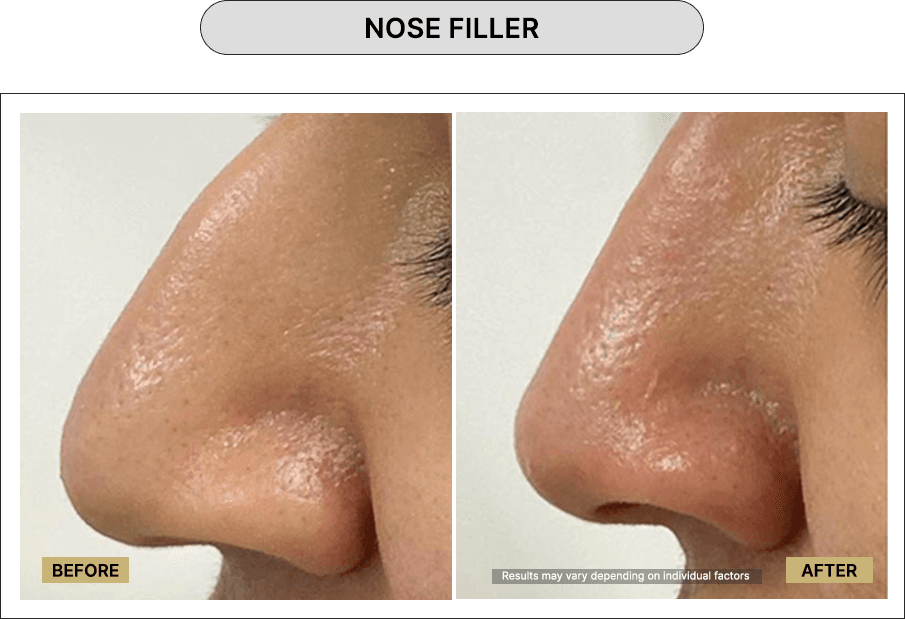 Nose Filler