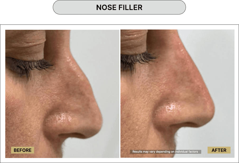 Nose Filler