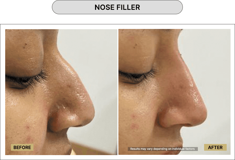 Nose Filler