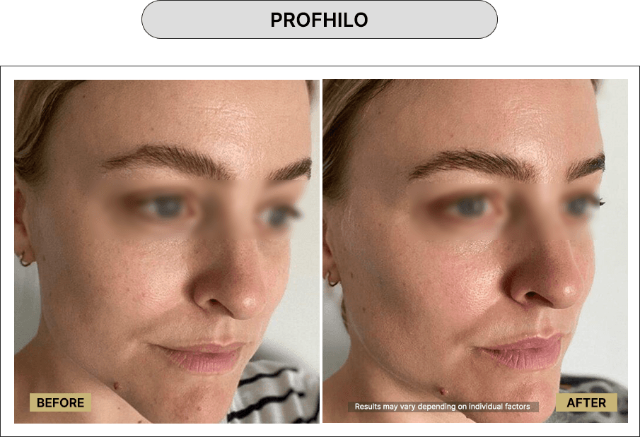 Profhilo