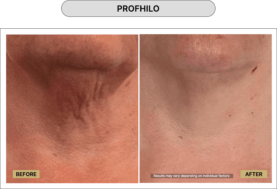 Profhilo