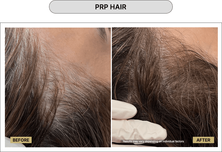 PRP hair