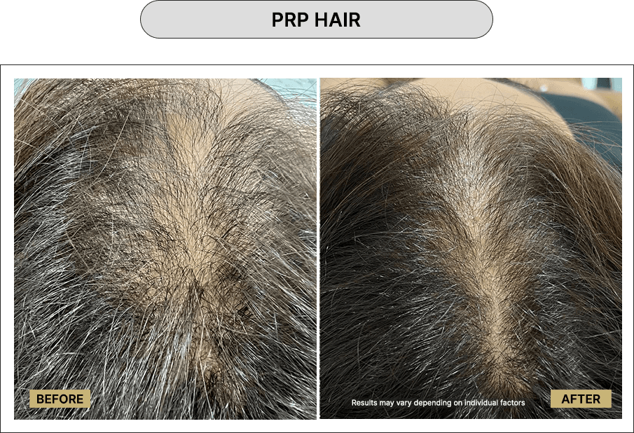 PRP hair