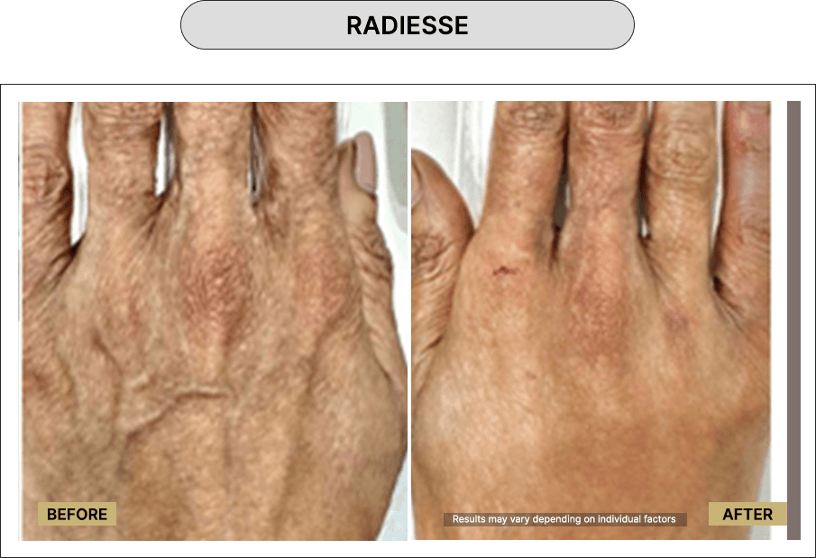 Radiesse