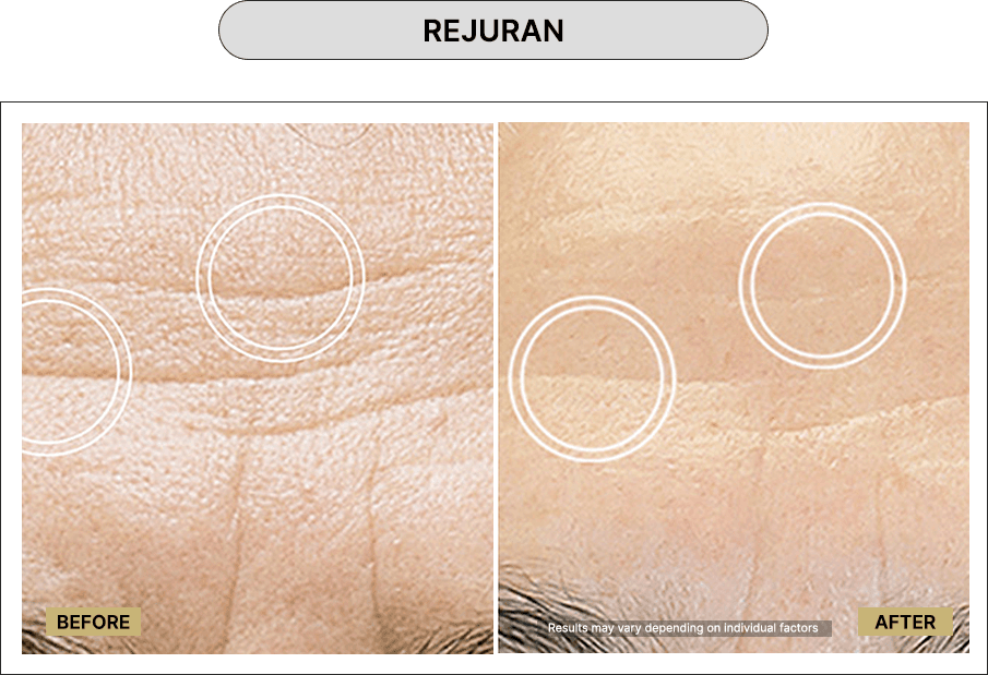 Rejuran
