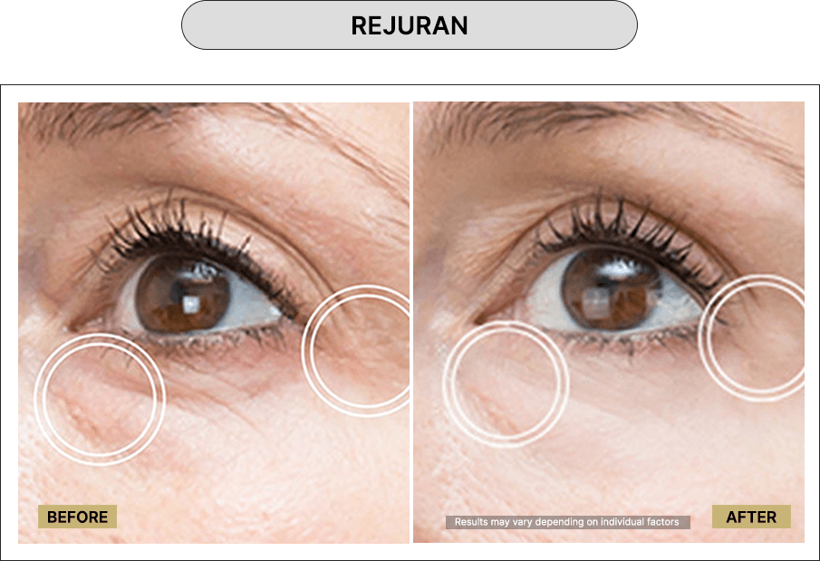 Rejuran