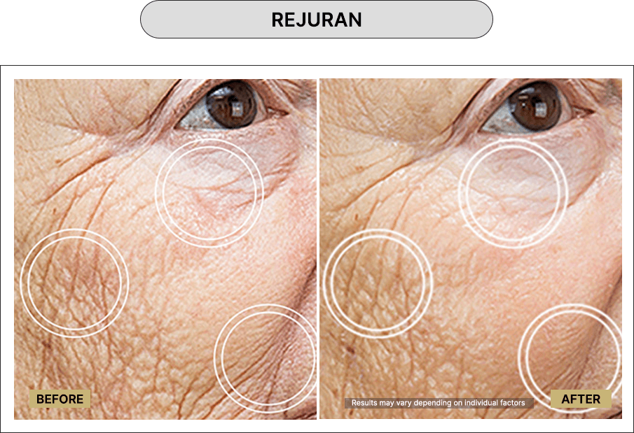 Rejuran