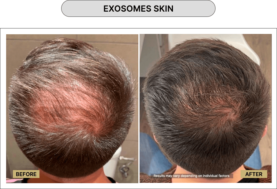 Exosomes Skin