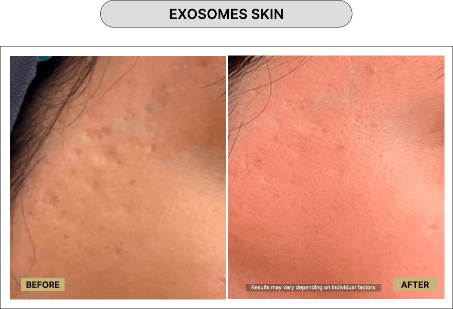 Exosomes Skin