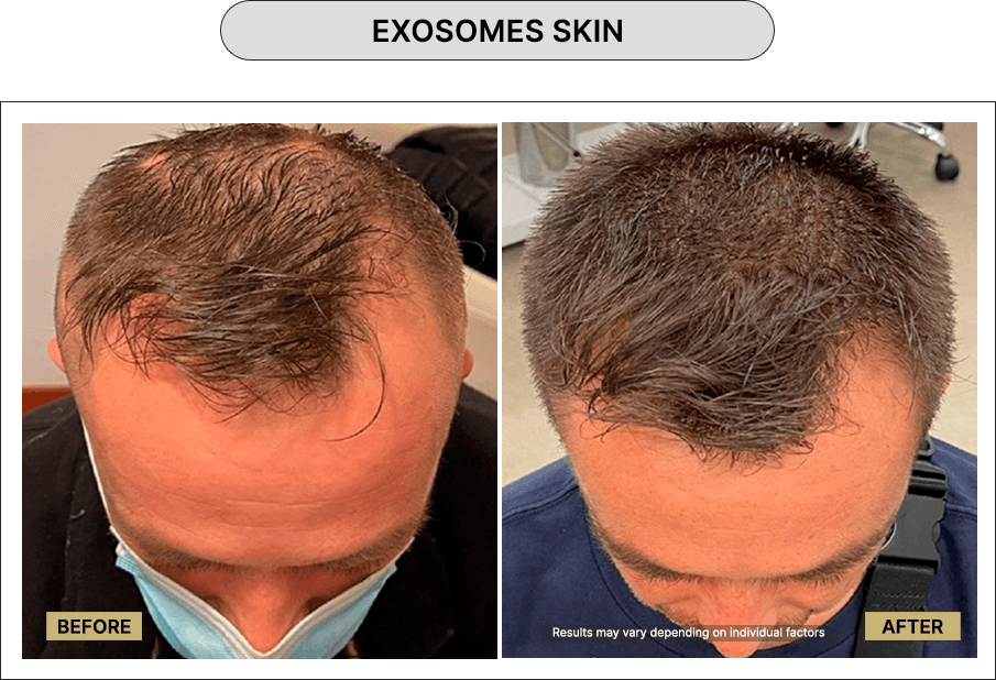 Exosomes Skin