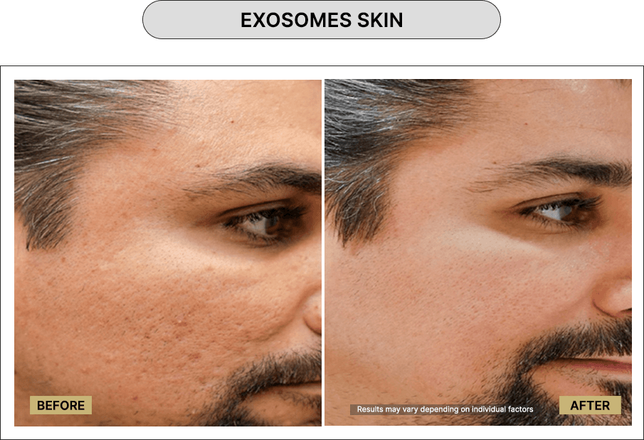 Exosome Skin