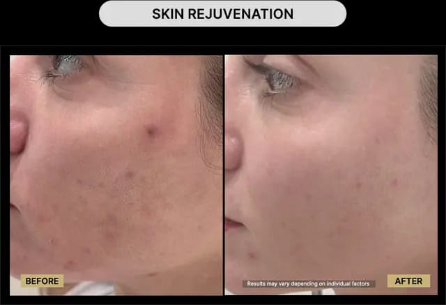 Skin Rejuvenation
