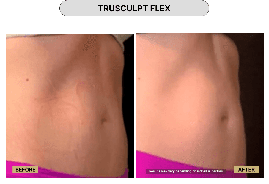 Trusculpt Flex