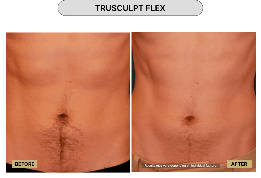 Trusculpt Flex