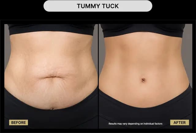 Tummy Tuck